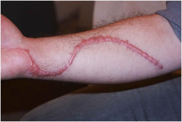 What is Scar and its types?