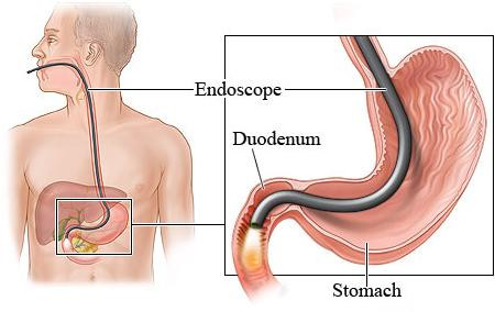 What is Endoscopy and its application?